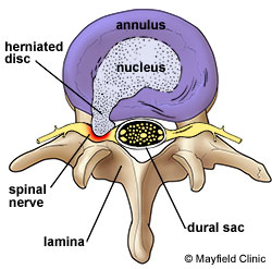 Axial view of herniated lumbar disc.